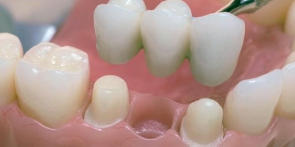 Что такое несъемное протезирование зубов